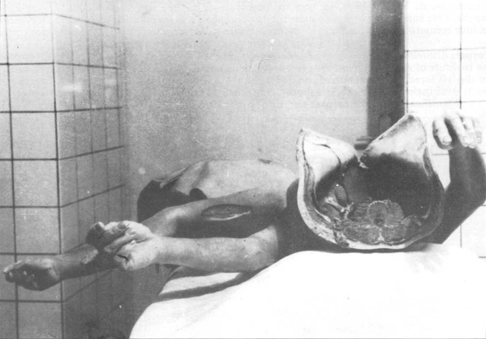 Dismembered cadaver